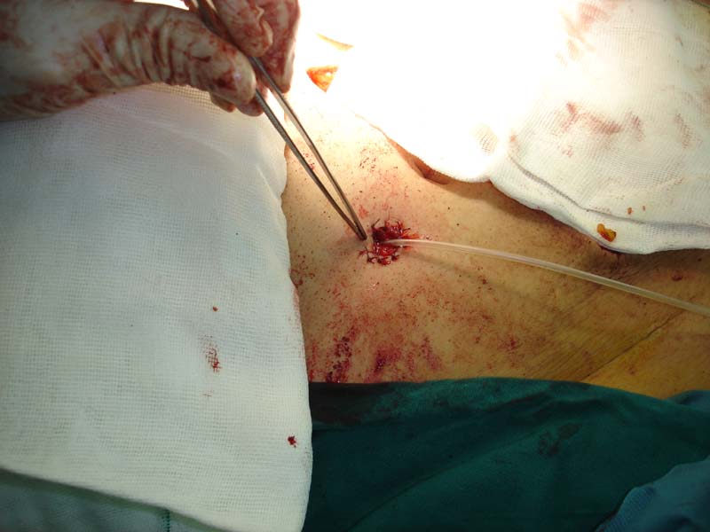 Appendectomy image